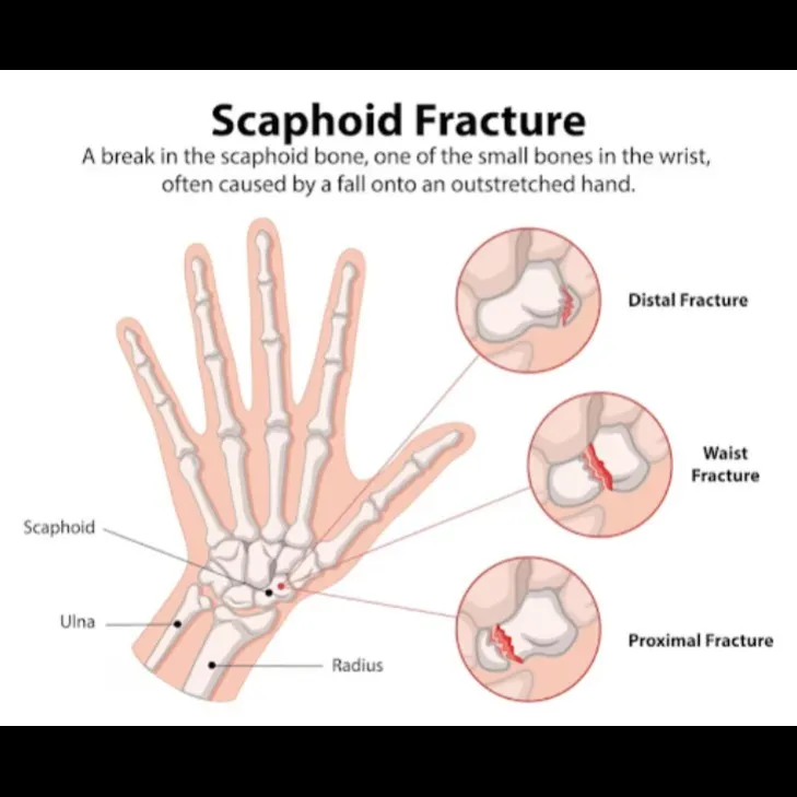 Scaphoid Fracture Non-Union Surgery in Bangalore – Rebuild Wrist Function and Strength