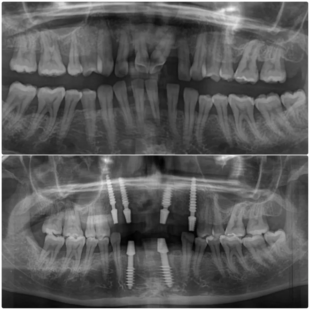 Orchards Dental Care – Expert Root Canal Treatment in Sadashivanagar Bangalore