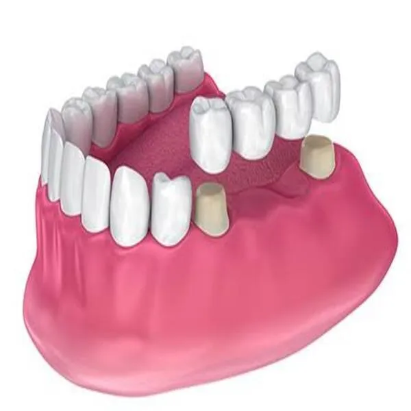 Crowns & Bridges Treatment in Greater Noida West β Restore Your Smile with P.D. Dental