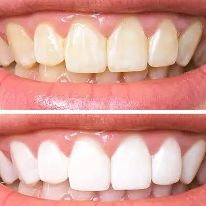 Discolored Tooth Restoration in Dhule