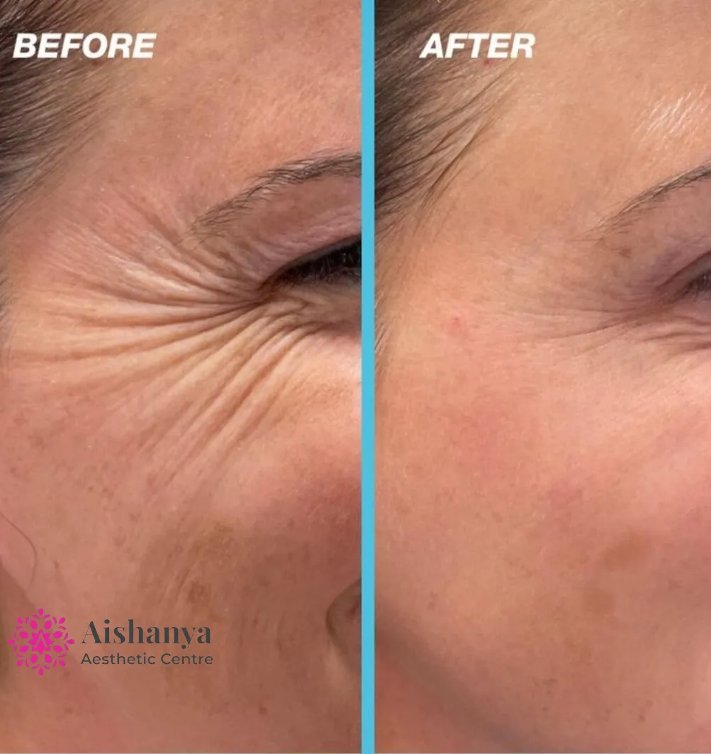 Best Botox Doctor in Dwarka, Janakpuri and Delhi NCR