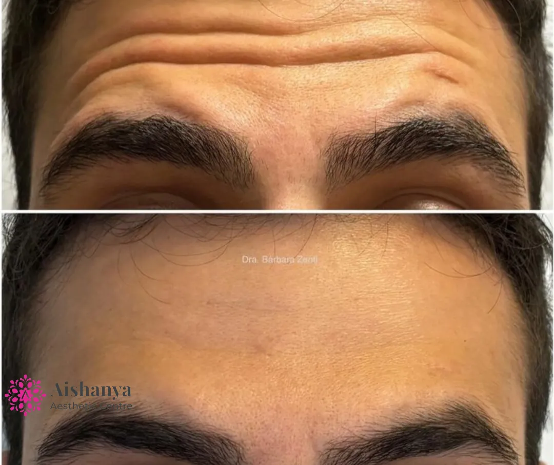Best Botox Doctor in Delhi NCR