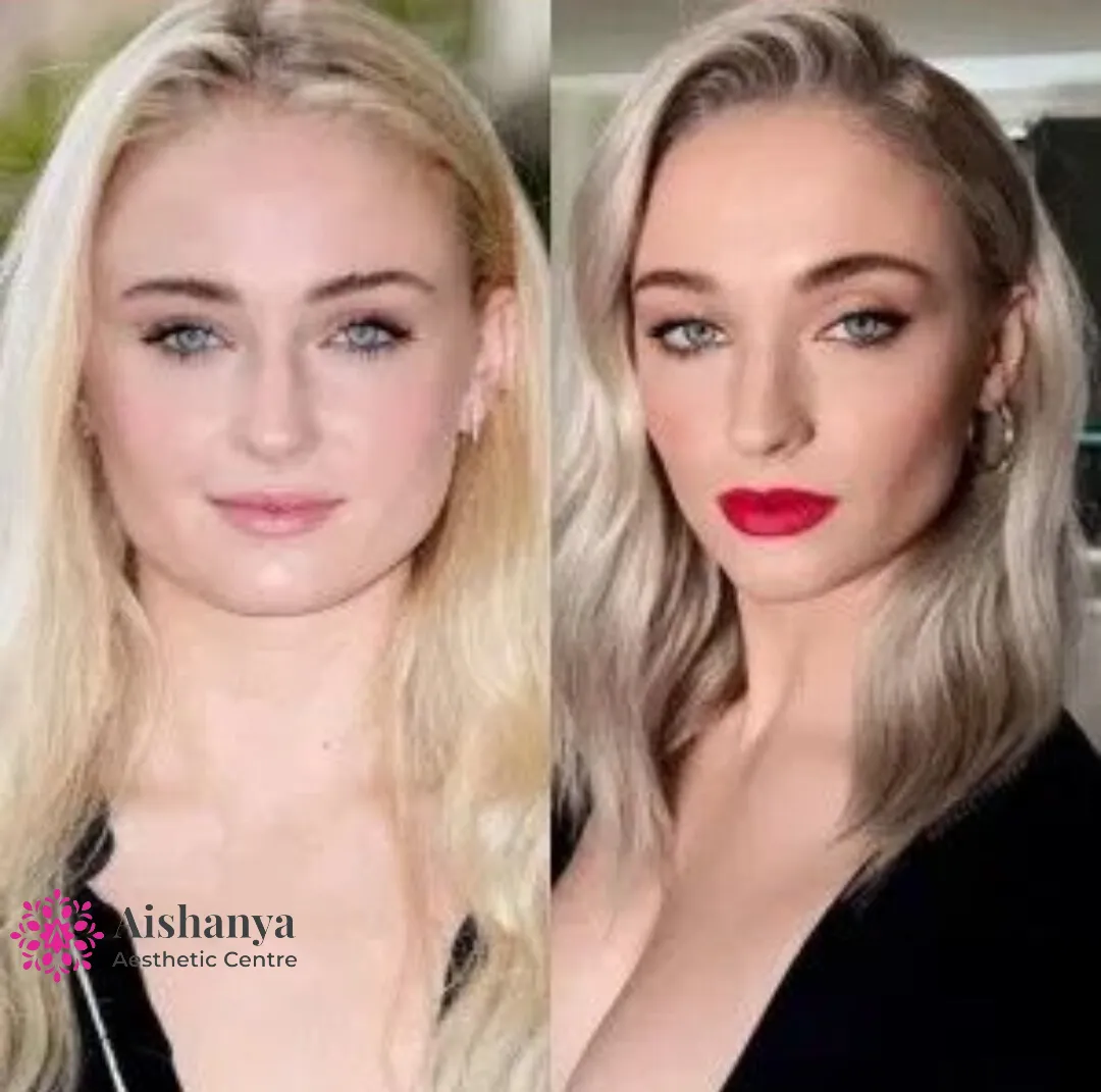 Best Botox Treatment for Jawline slimming in Delhi NCR, Dwarka and Janakpuri