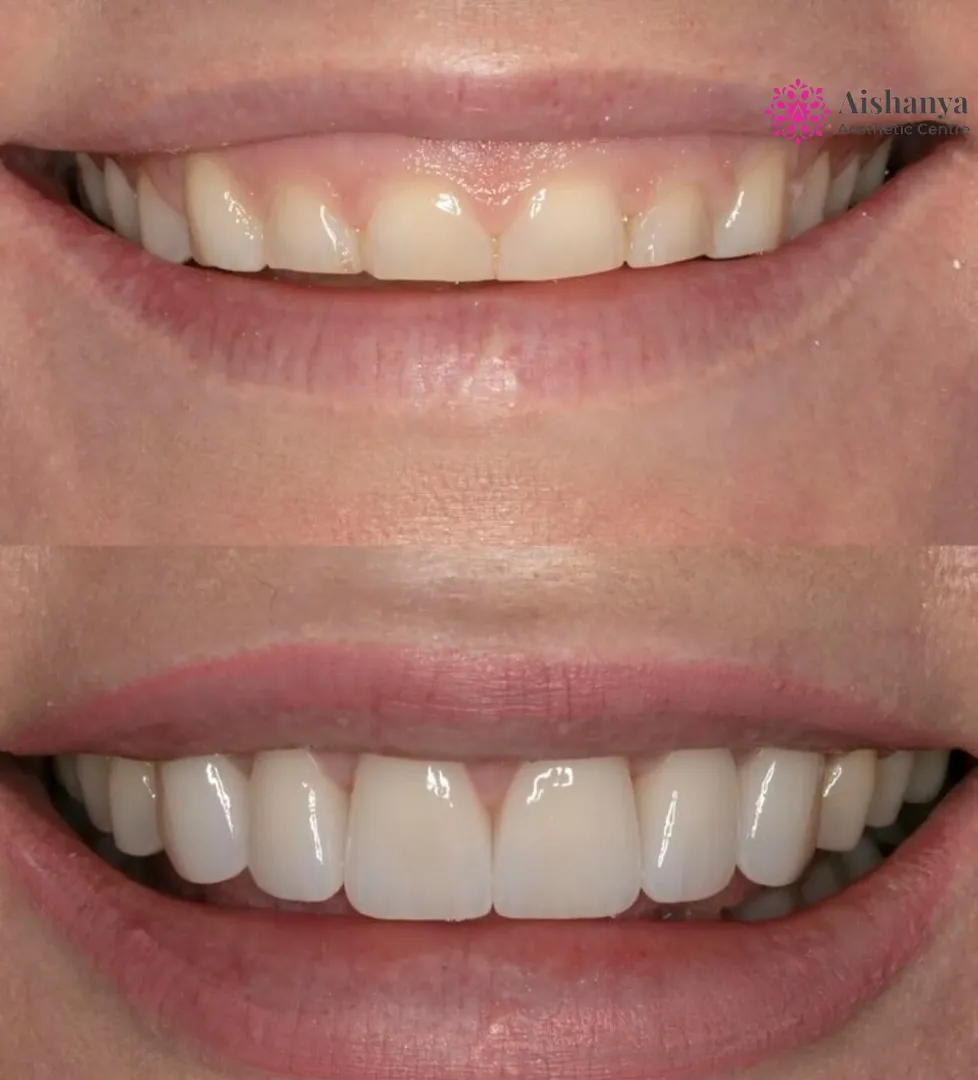 Best Botox Treatment for Gummy Smile in Dwarka, Delhi NCR @Aishanya Aesthetic Centre