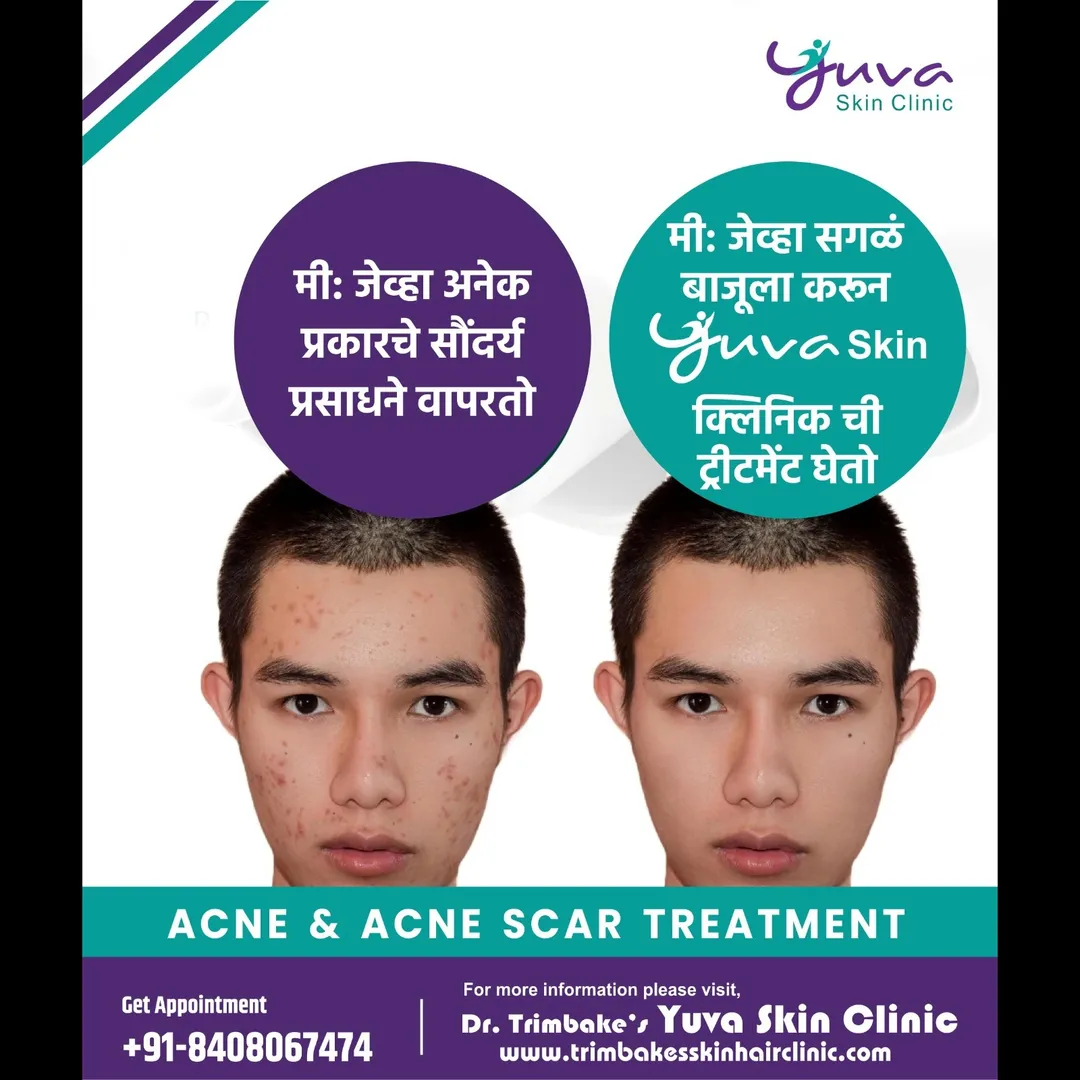 Acne & Acne Scar Treatment
Acne can be a nightmare for many. Many times, when an acne on your skin g...