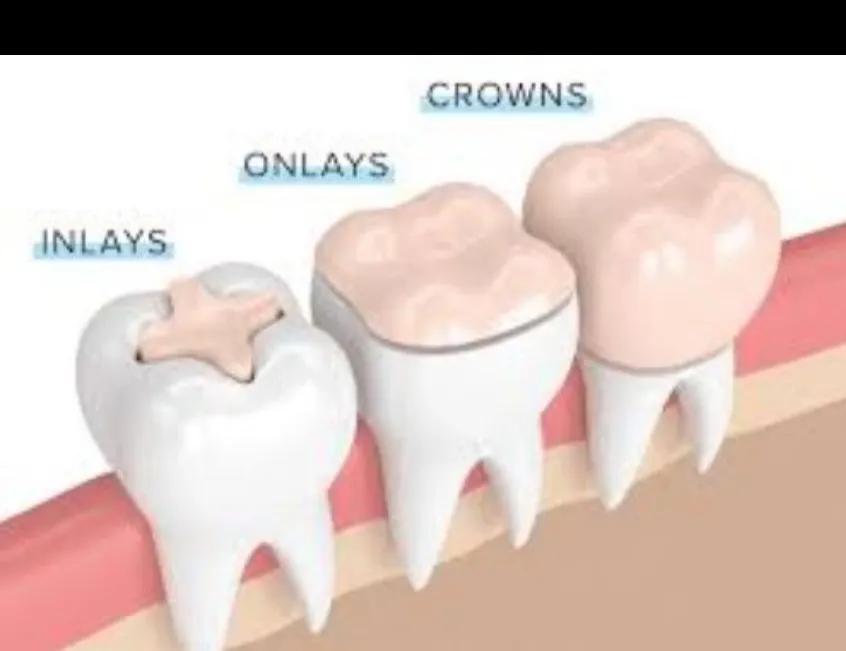 Dental Inlays and Onlays in Greater Noida West