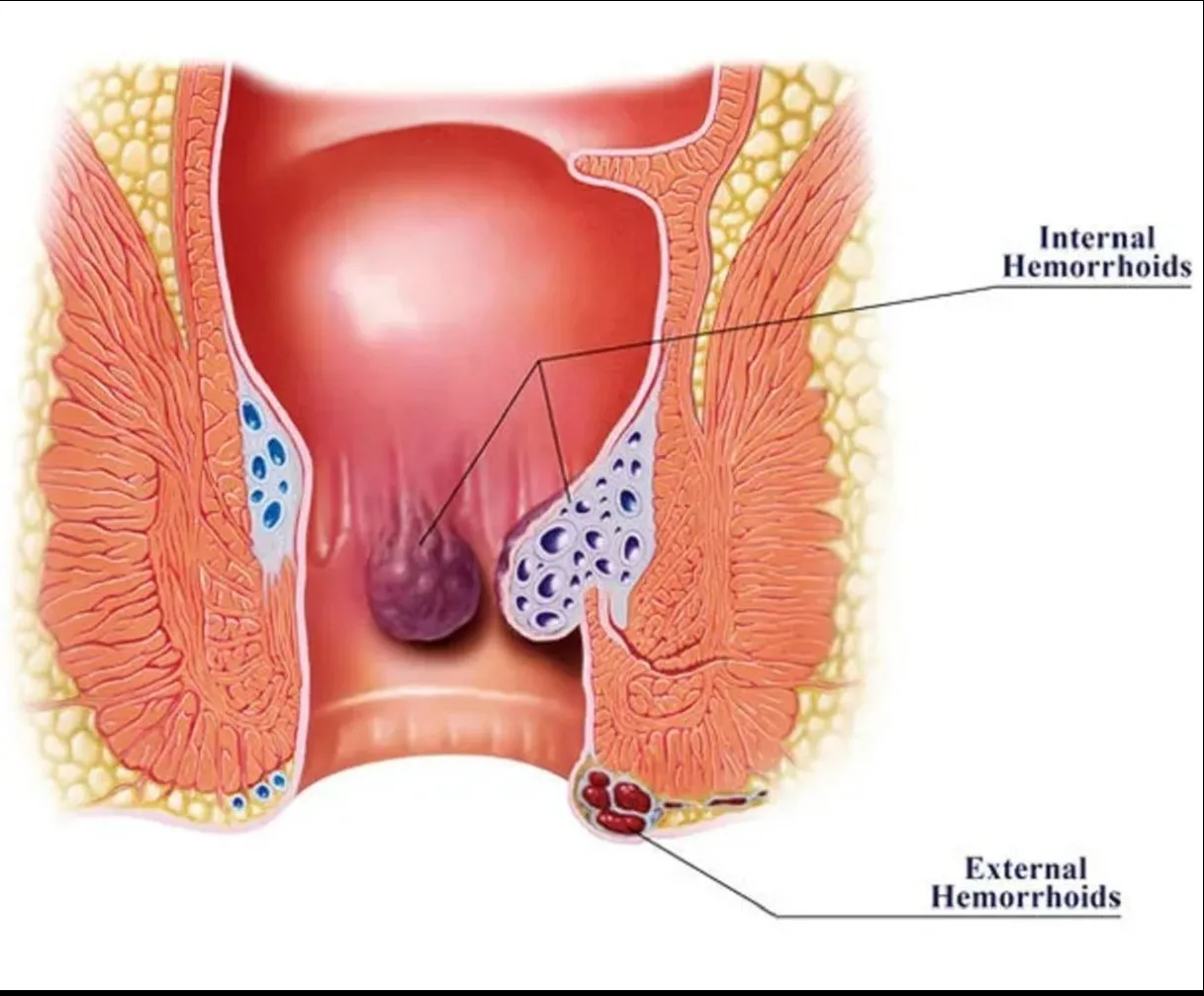Piles Removal Surgery in Kurla – Gentle Solutions for Lasting Relief