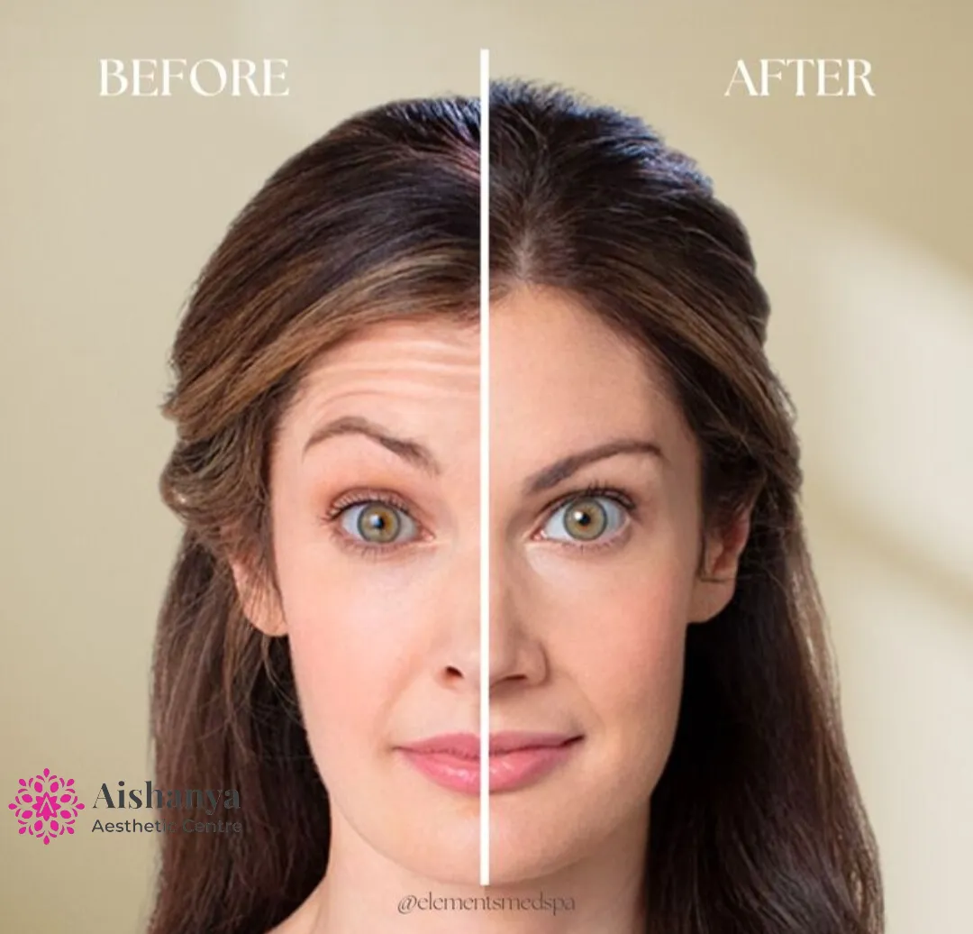Affordable Botox Treatment in Dwarka ,Janakpuri and Delhi NCR @Aishanya Aesthetic Centre
