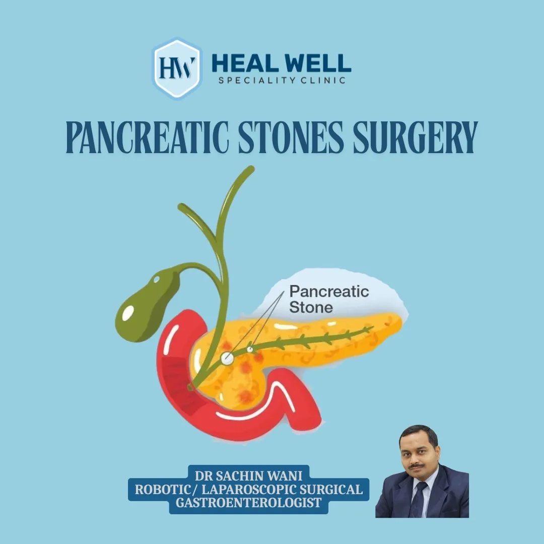 Pancreatic Stones Surgery in Thane