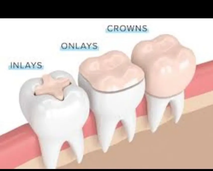 Dental Inlays and Onlays in Dhule – Expert Restorative Dentistry at Gindodia Hospital
