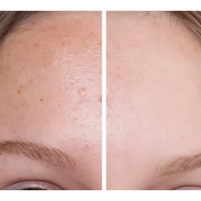 Pigmentation Treatment In Chennai For Even-Toned Skin