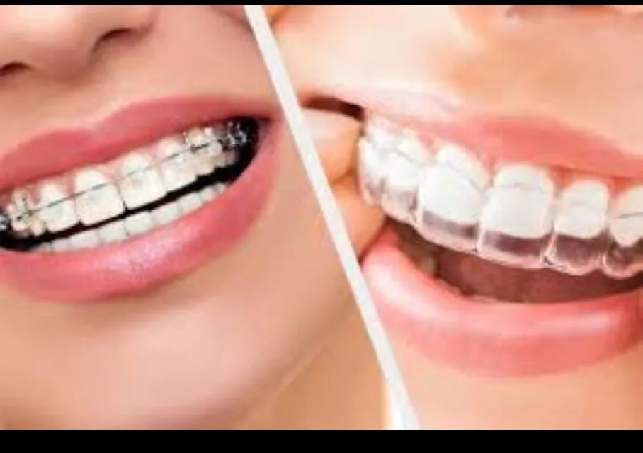 Orthodontics Treatment in Greater Noida West – P.D. Dental