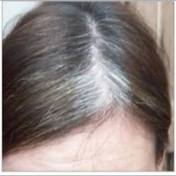 Grey Hair Treatment in Dhule – Gindodia Hospital