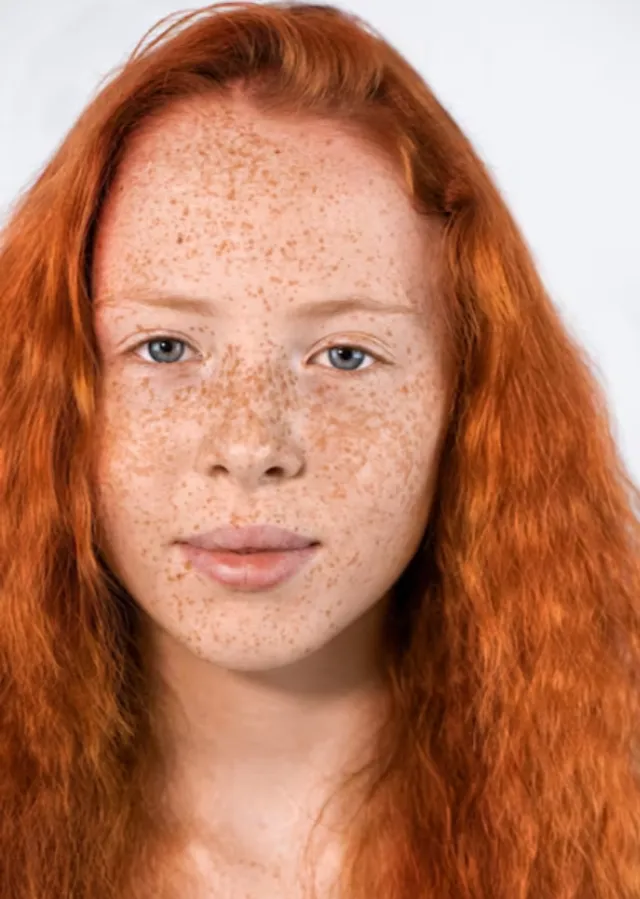 Freckles and Lentigines Treatment in Dhokali – Even Out Your Skin Tone Safely