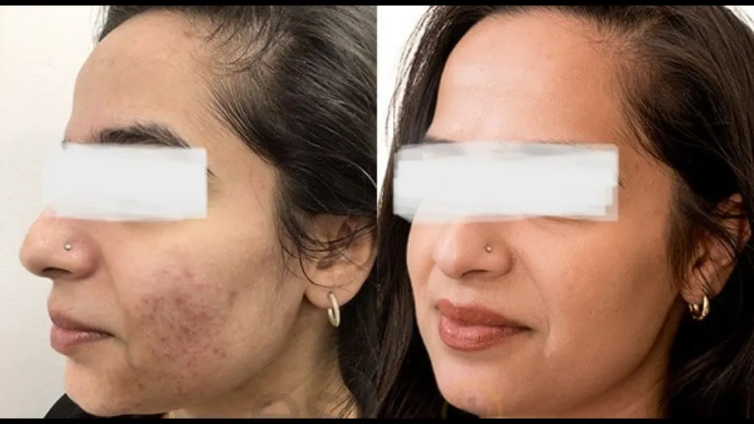 ✨ Break free from acne in Brahmand