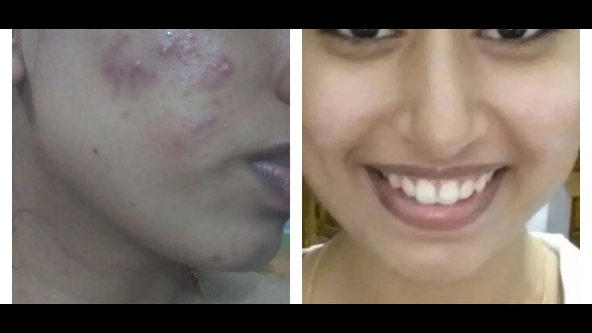 ✨ Get expert acne care at Kasarvadavli, Thane with Dr. Bhagyashri.