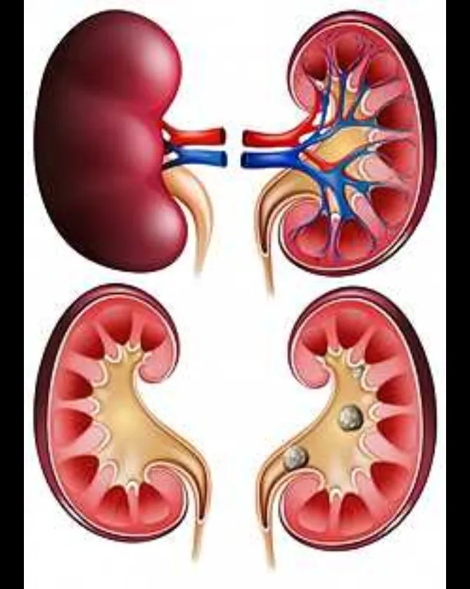 Kidney Stone Treatment in Thane West: Fast, Safe, and Reliable Care