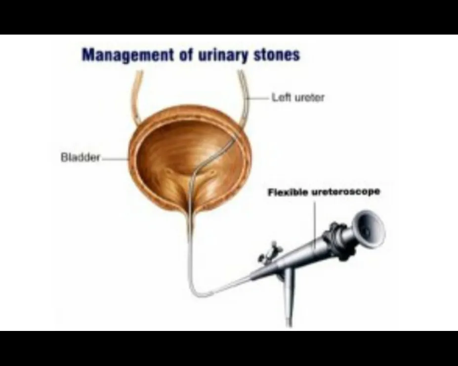 Laser Stone Removal in Thane West: Safe, Painless, and Quick