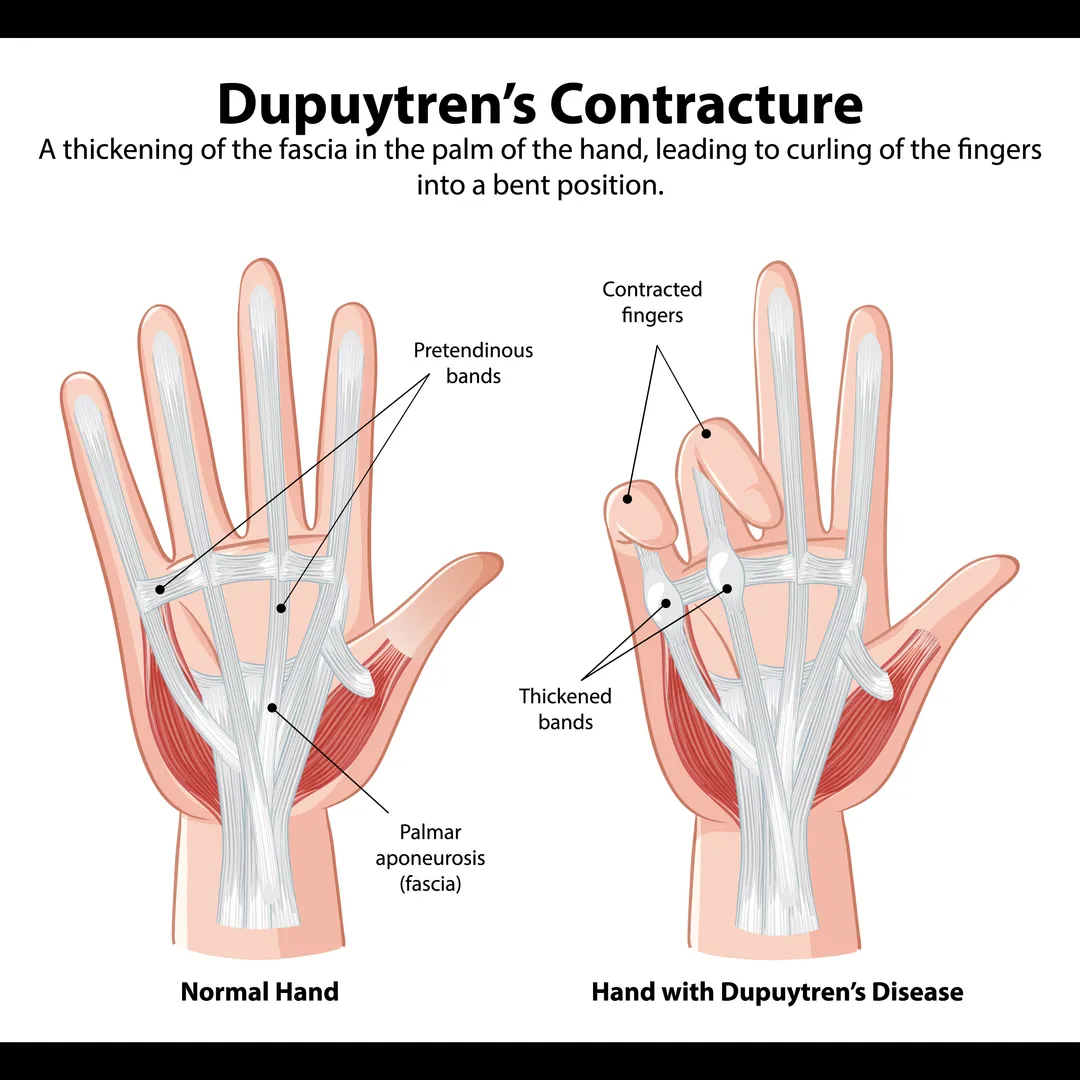 Dupuytren's Contracture Surgery in Bangalore – Restore Finger Movement and Hand Utility