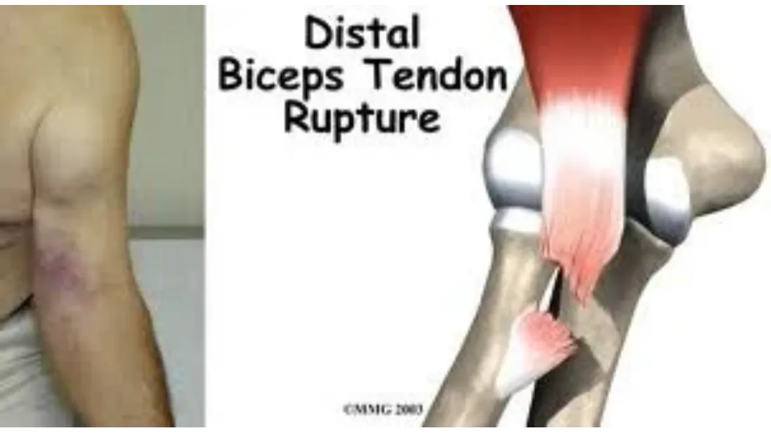 Synthetic Collagen Matrix for Tendon Repair in Bangalore – Innovative Solution for Tissue Healing