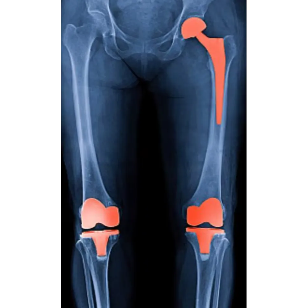 Knee and Hip Replacement in Pimpri-Chinchwad