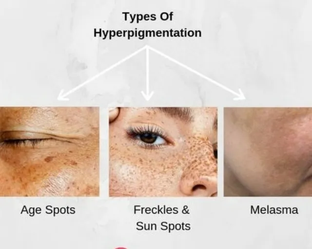 π Say Goodbye to Skin Pigmentation with Expert Dermatologist in Thane at Kalloes Skin Clinicπ