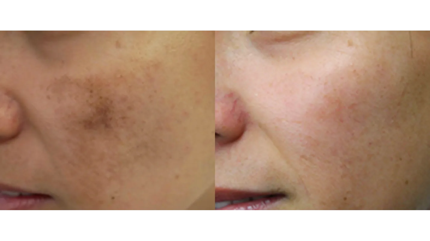 ๐ Say Goodbye to Skin Pigmentation with Expert Dermatologist in Majiwada! Kalloes Skin Clinic๐