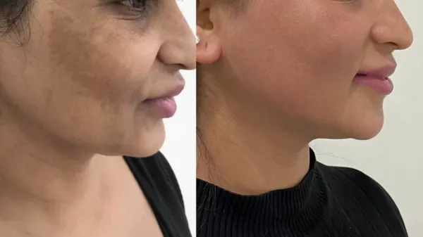 π Say Goodbye to Skin Pigmentation with Expert Dermatologist in Brahmand at kalloes Skin Clinicπ