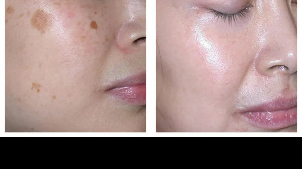 π Say Goodbye to Skin Pigmentation with Expert Dermatological Care in Hiranandani Estateπ