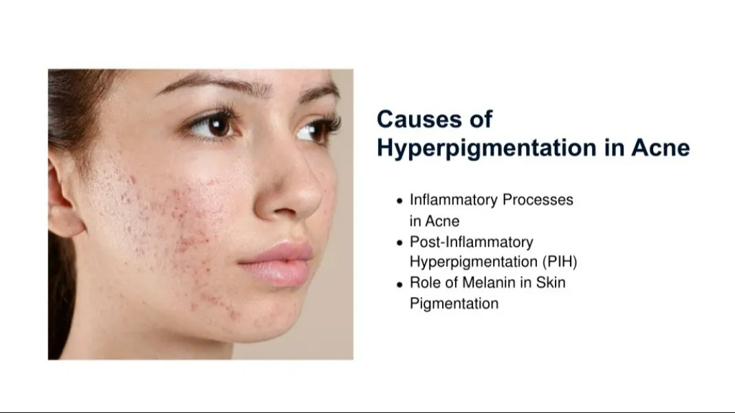 π Say Goodbye to Skin Pigmentation with Expert Dermatological Care in AIroli Kalloes Skin Clinicπ