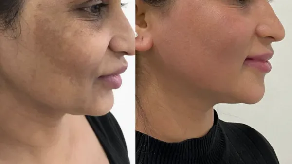 π Say Goodbye to Skin Pigmentation with Expert Dermatological Care Rabaleπ