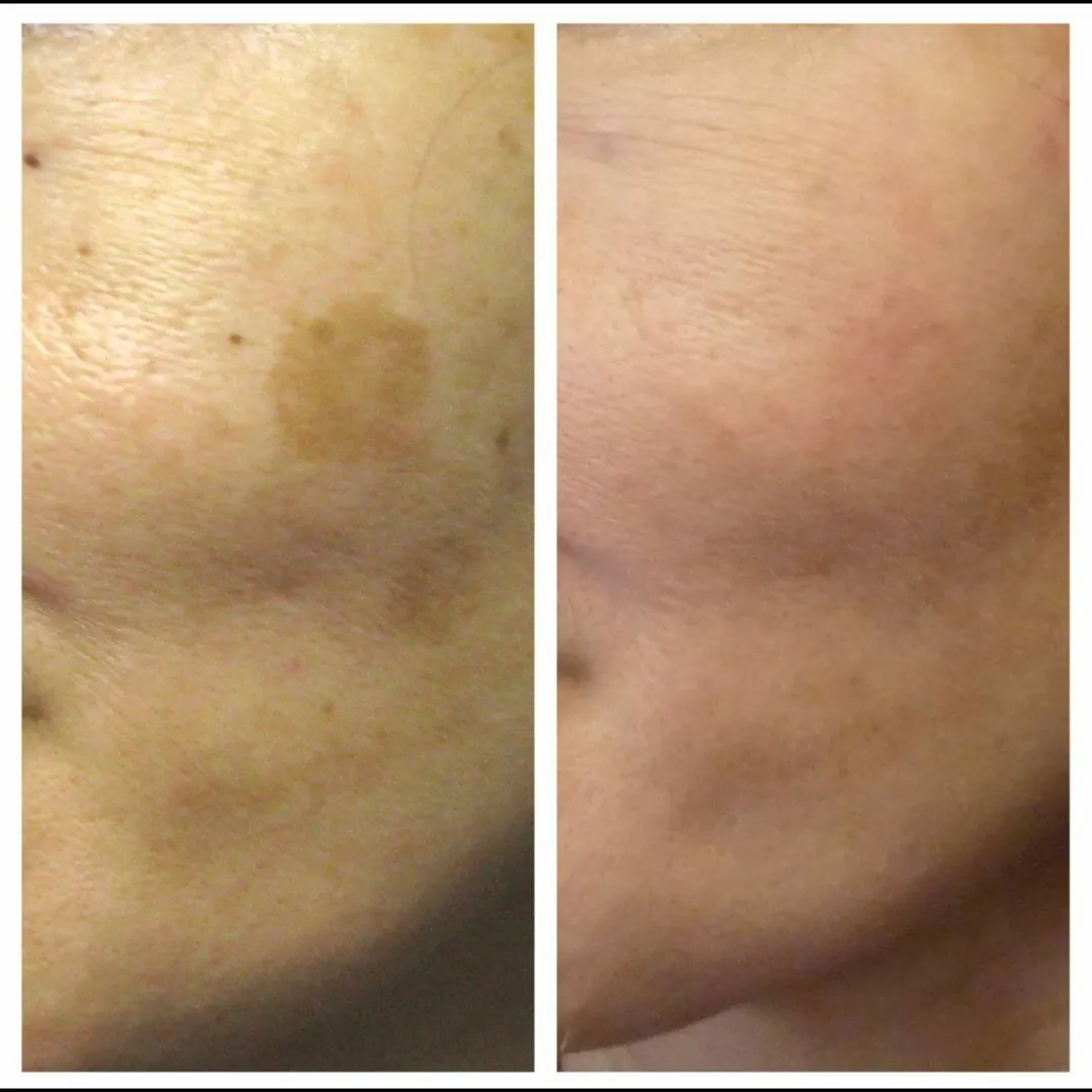 π Say Goodbye to Skin Pigmentation with Expert Dermatological Care Kalyan At Kalloes Skin Clinic π