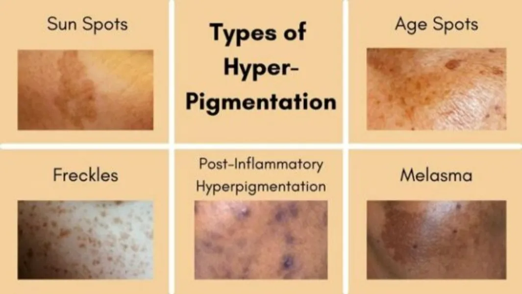 π Say Goodbye to Skin Pigmentation with Expert Dermatologist in Dombivali At Kalloes Skin Clinicπ