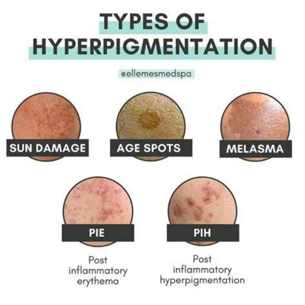 π Say Goodbye to Skin Pigmentation with Expert Dermatological Care in Kasarvadavli Kalloes Skin π
