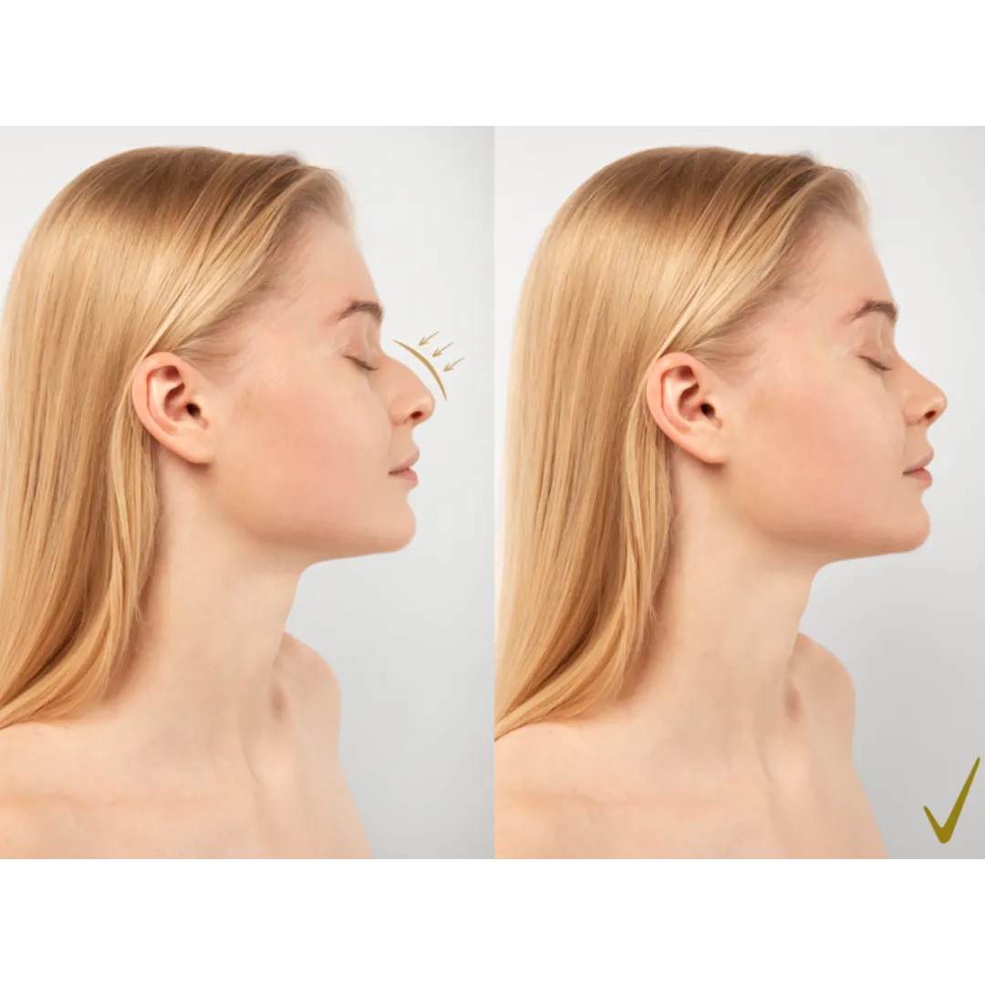 Rhinoplasty Surgery in Bangalore – Achieve a Balanced and Harmonious Facial Look