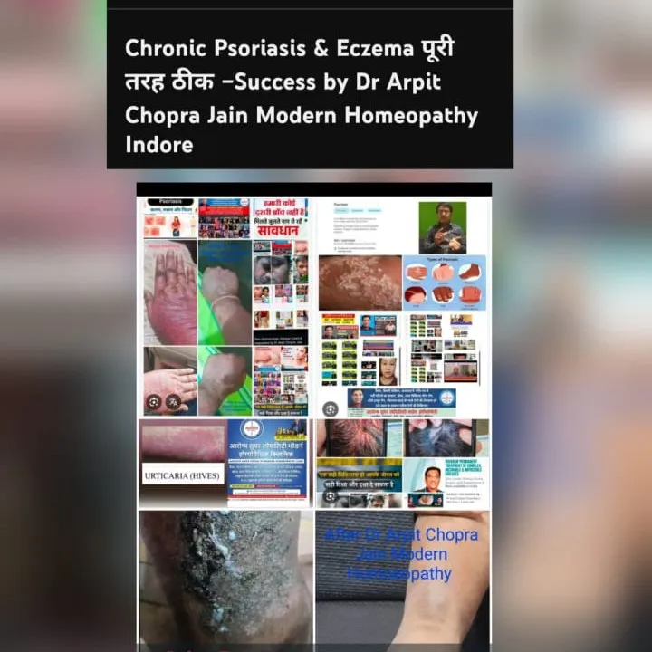 Psoriasis & Skin Disease Cured, Responded by Dr Arpit Chopra Jain Aarogya Super Modern Homoeopathy I...