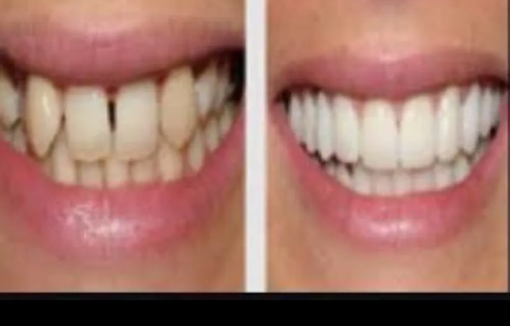 Smile Designing in Greater Noida West | P.D. Dental Clinic