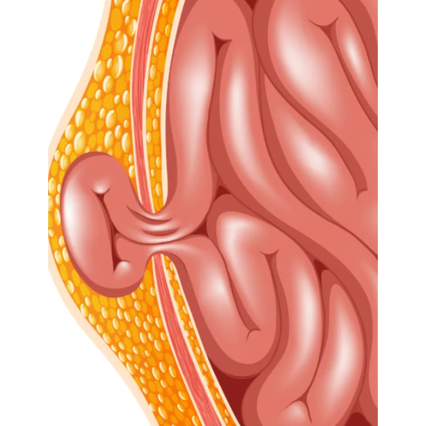 Hernia Surgeon in Kolathur, Chennai – Trusted Surgical Expertise for Quick Recovery