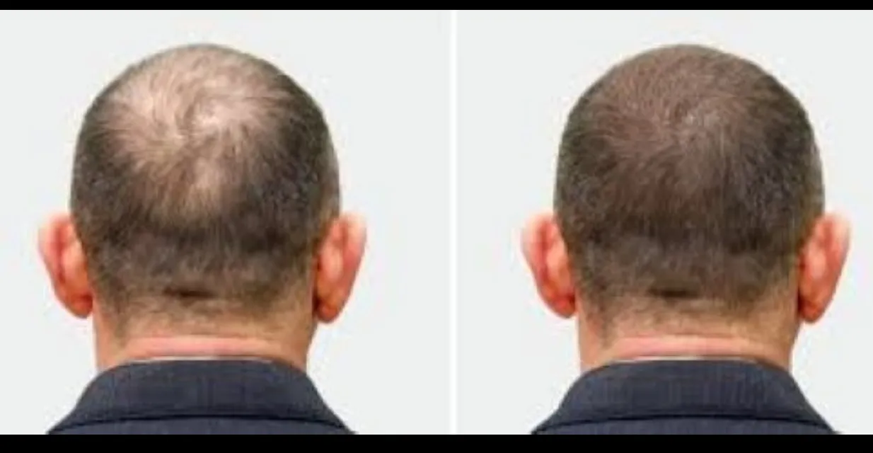 Best Hair Transplant Hospital in Dhule – Gindodia Hospital