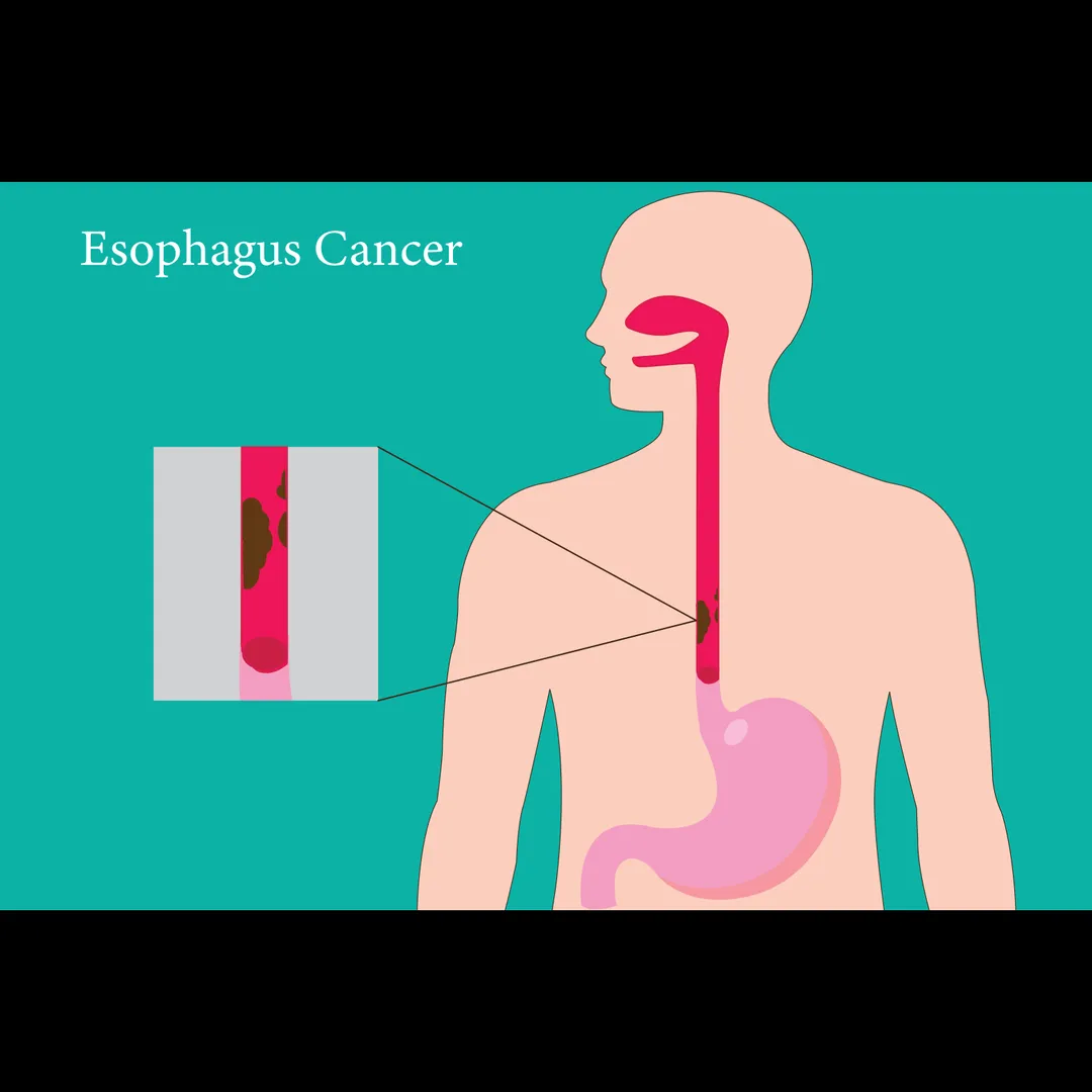 Esophageal Cancer Surgery Near Hesaraghatta with Robotic Precision – Faster Recovery, Better Outcome