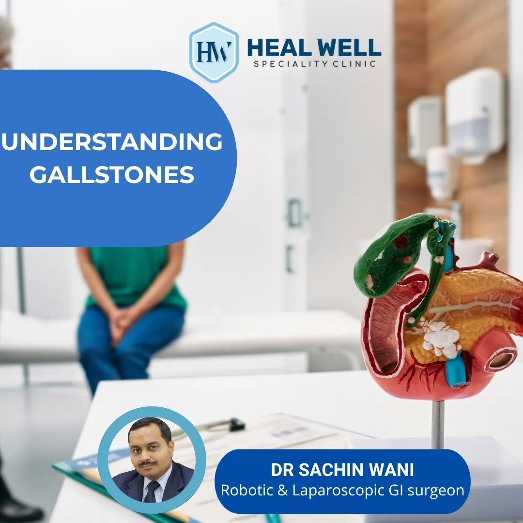 Understanding Gallstones: Causes, Symptoms and Treatment in Thane