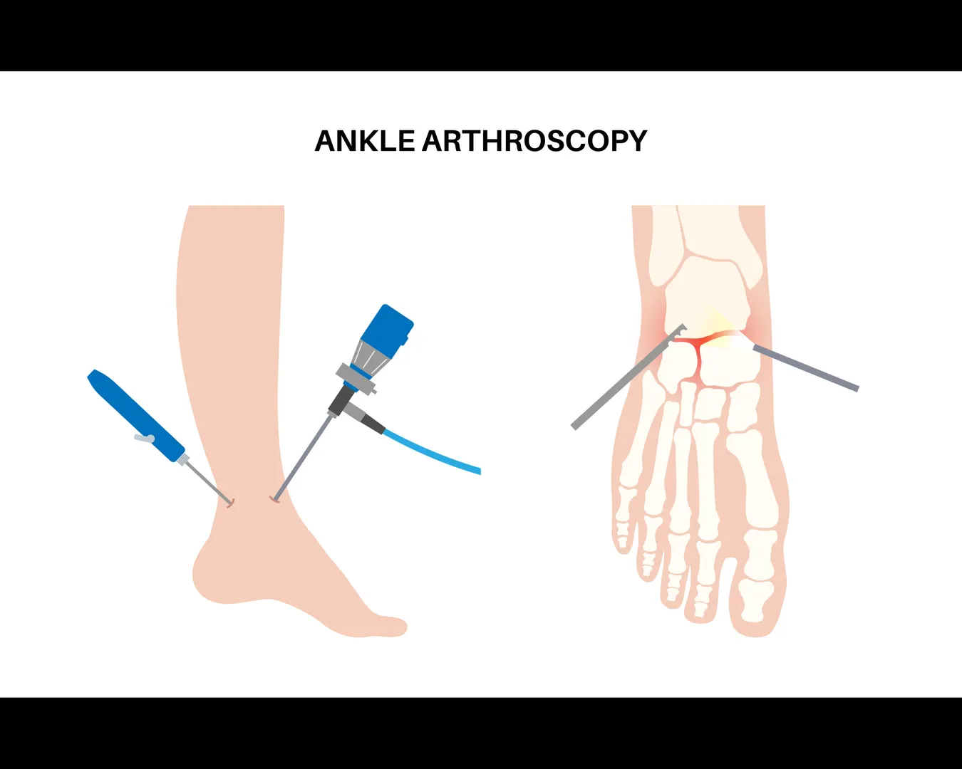 Ankle Arthroscopy and Ligament Repair in Bangalore – Precision Care for Lasting Ankle Stability
