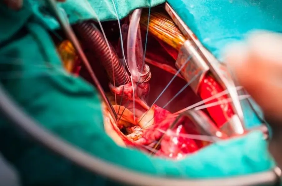 Coronary Bypass Surgery in Pune – A Life-Saving Path When Arteries Narrow