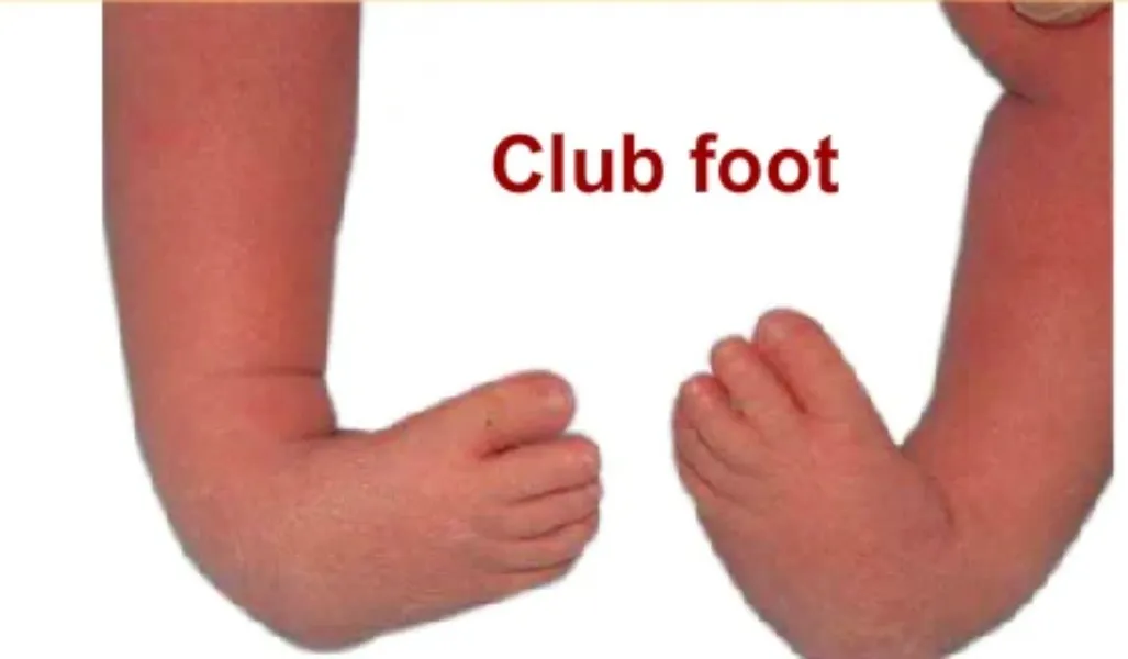 Clubfoot Treatment Doctor in Nagpur – Corrective Solutions for Foot Deformities