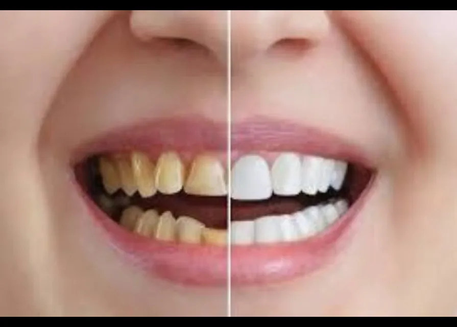 Aesthetic Dentistry in Gaur City Noida Extension | P.D. Dental