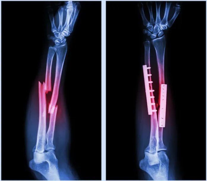 Fracture Fixation in Yelahanka