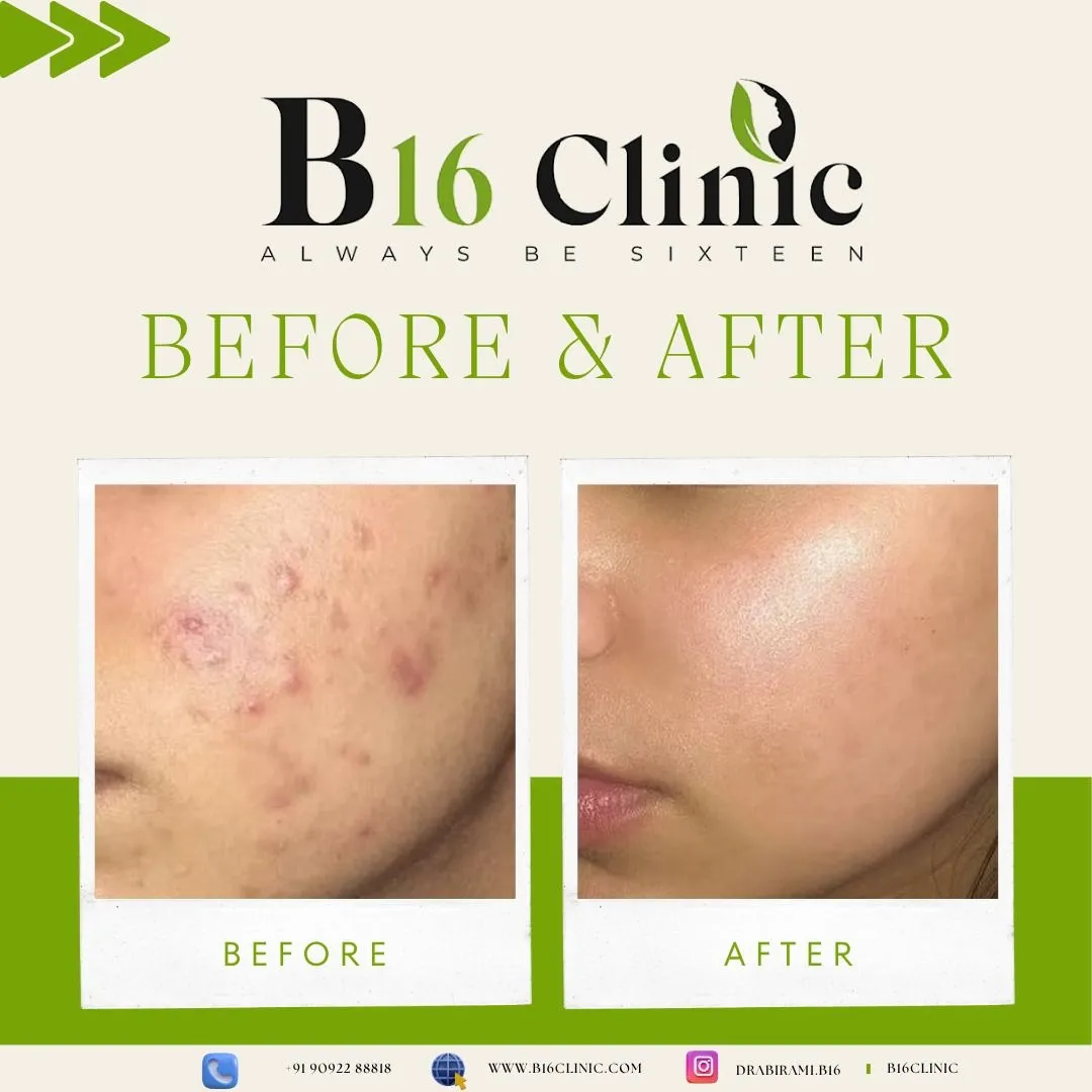 ✨ Say Goodbye to Acne, Hello to Clear Skin! ✨