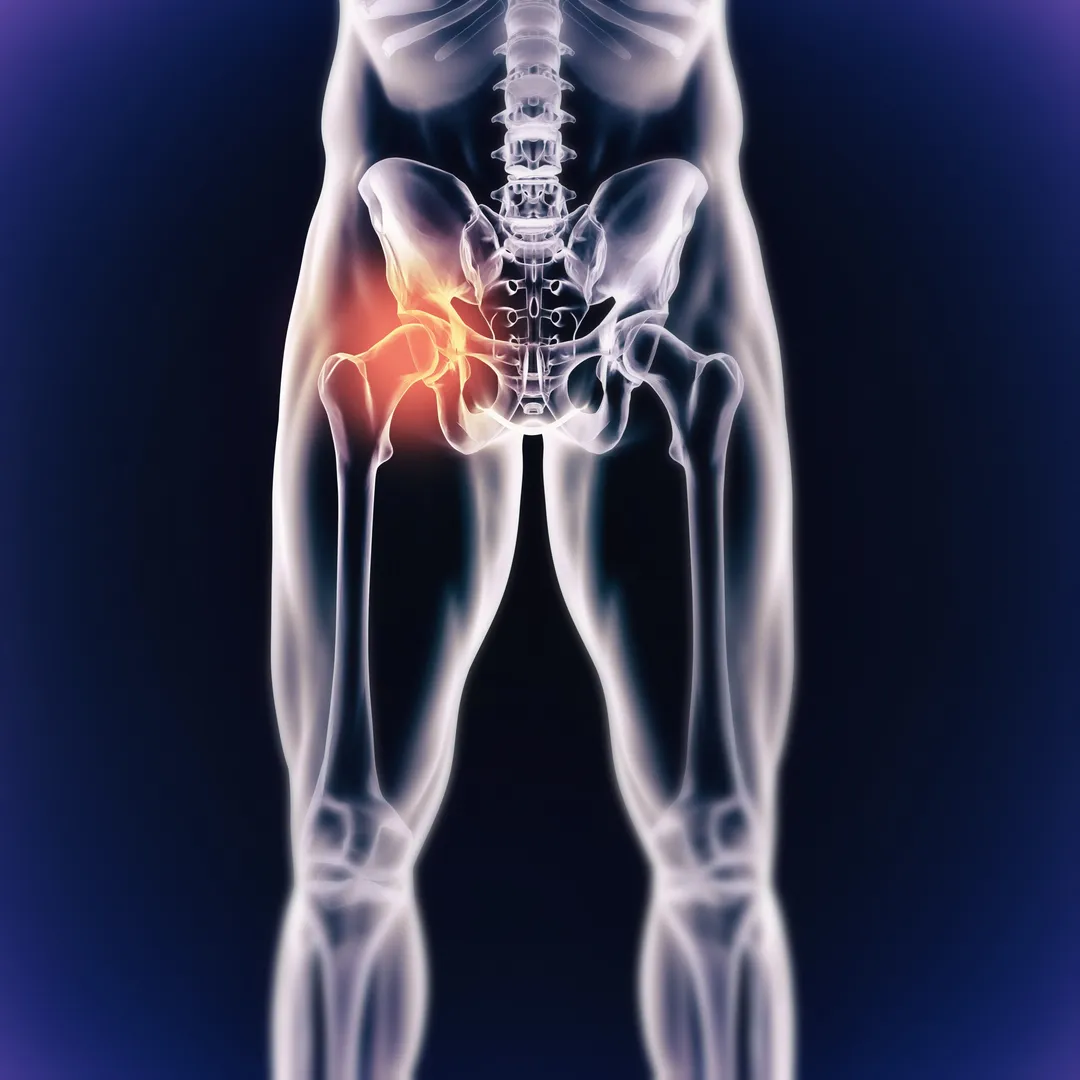Robotic Hip Replacement in Nagpur