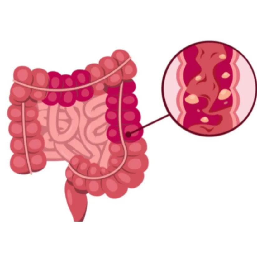 Inflammatory Bowel Disease (IBD) Treatment in Mumbai