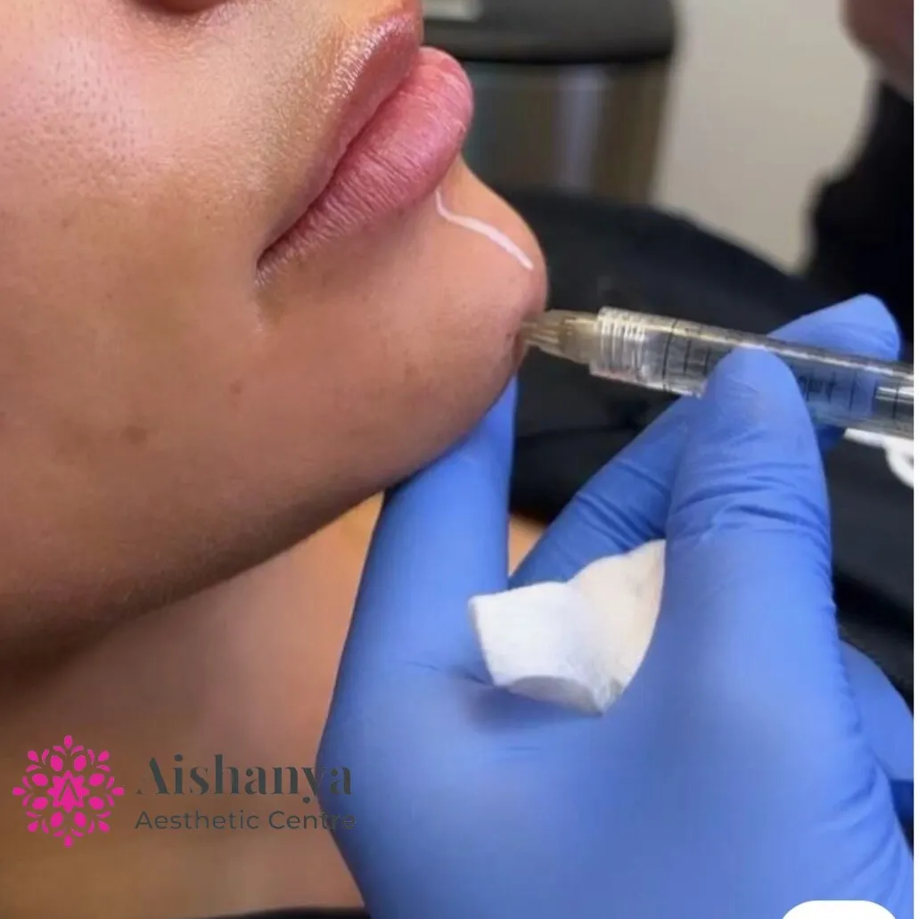 Best Filler treatments in Janakpuri, Dwarka and Delhi